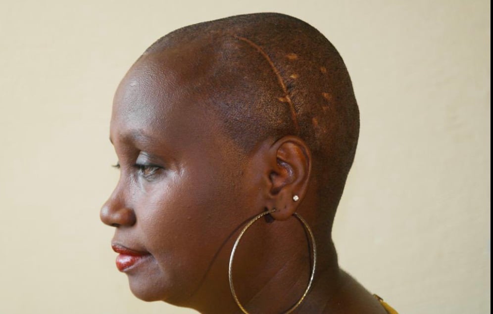 Kayitesi yaratemwe bikomeye muri Jenoside yakorewe Abatutsi