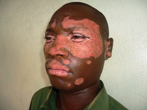 Iyi ndwara ayimaranye imyaka 10 ariko yanze gukira.