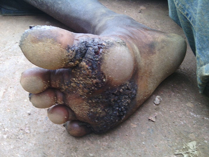 Akeka ko amavunja arwaye ari amarogano kuko bagerageje kumuhandura ariko akanga akiyongera ari nako amubabaza cyane.