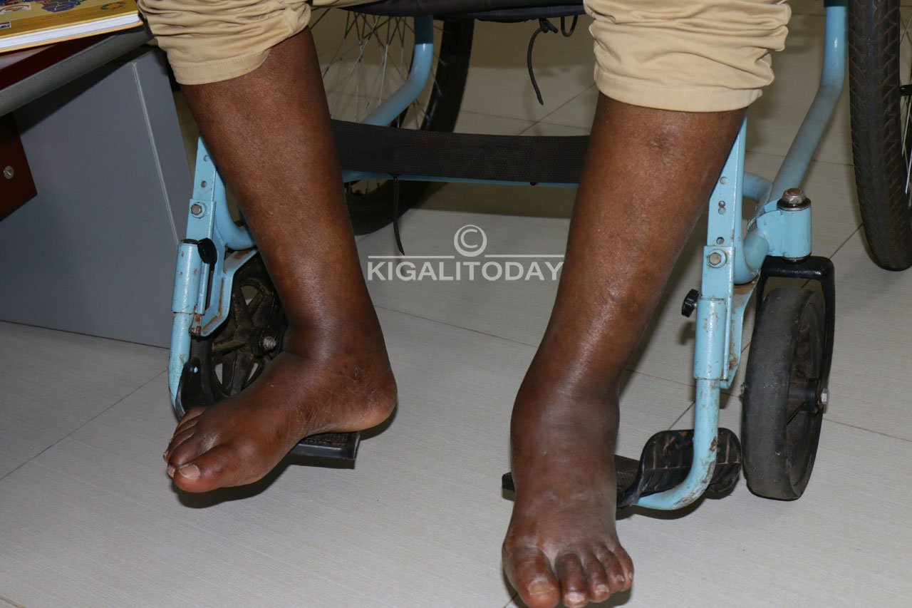 Amaguru yarabyimbye kuburyo kugenda bitazamworohera