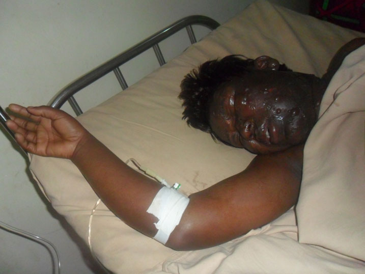 Tuyishimire yagize ubushye bukomeye.