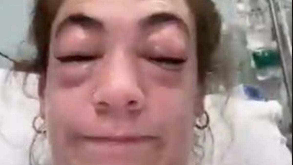 Komeka ingohe hari abo bitera kumererwa nabi ku mubiri (allergies)