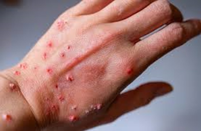 Mu Bwongereza hamaze kugera mpox yagaragaye bwa mbere muri RDC