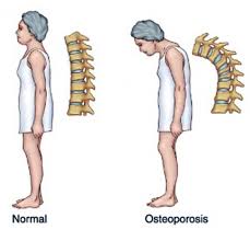 Iyi ndwara itera bamwe kugenda bunamye (Foto: Nairobi Spine and Orthopaedic Centre)