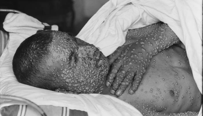 Icyorezo cya smallpox kiri mu byahitanye abantu benshi ku isi (Photo:Internet)