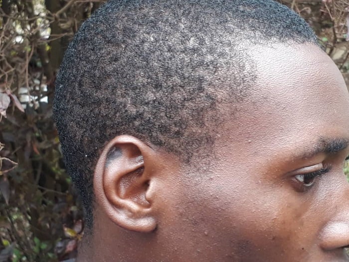 Inkovu Twambazimana afite ku gutwi yayitewe n'urushyi yakubitiwe muri gereza