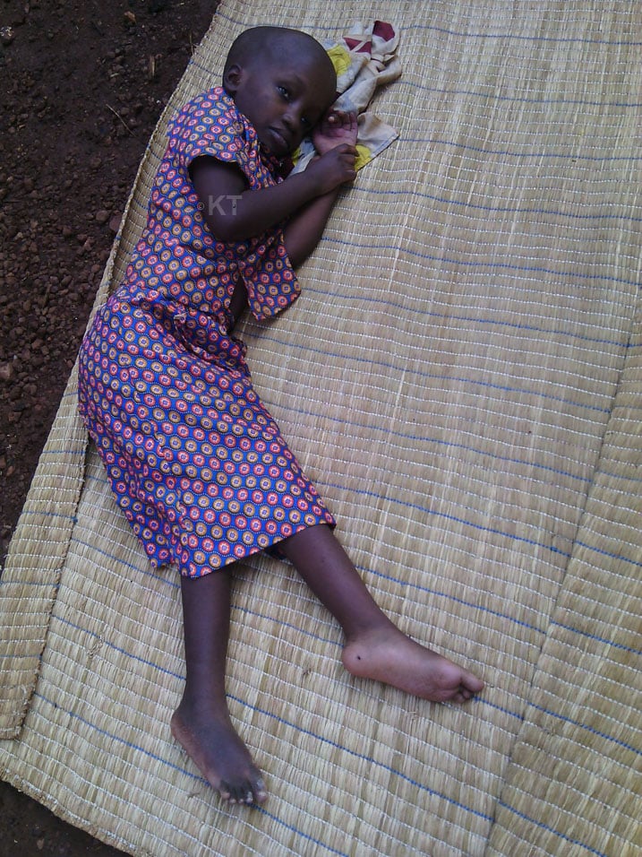 Uyu mwana afite indwara yavukanye yaberanye.