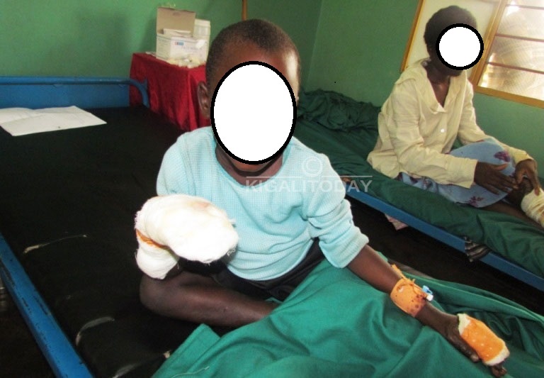 Uyu mwana w'imyaka umunani y'amavuko yatwitswe na se ibiganza amuziza guca ikigori mu murima