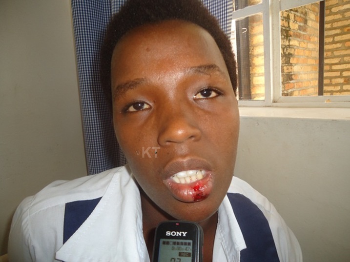 Uyu yakubiswe urutsinga ku munwa.